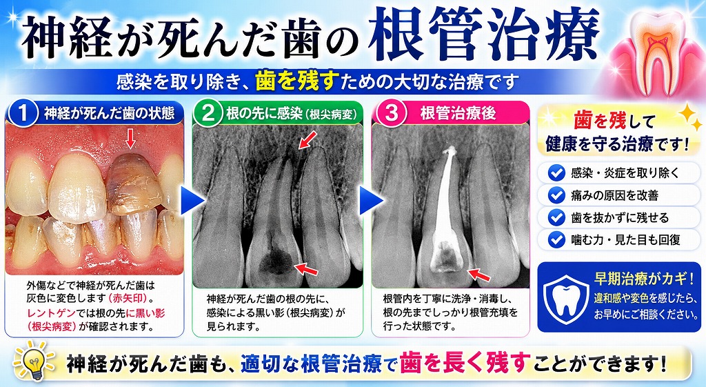 神経が死んだ歯の根管治療