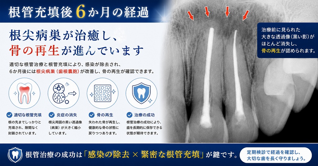 根管充填後6か月の経過