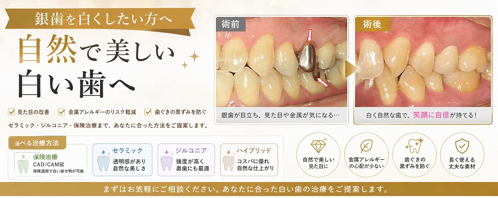 銀歯を白くしたい方へ　自然で美しい白い歯へ