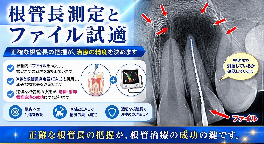根管長測定とファイル試適