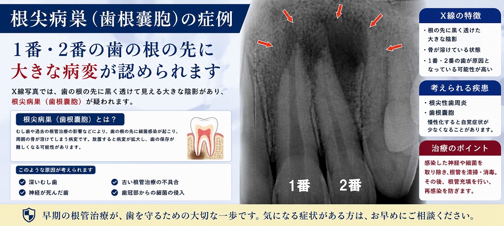 根尖病巣（歯根嚢胞）の症例