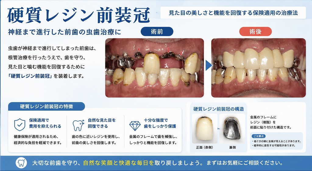 保険診療で使用される硬質レジン前装冠とは