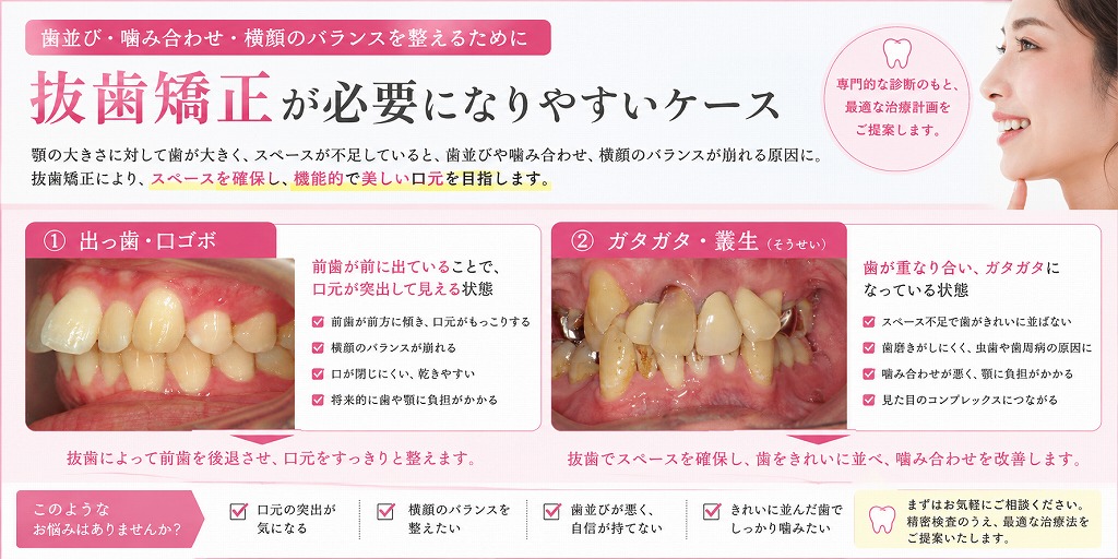 抜歯矯正が必要になりやすいケース