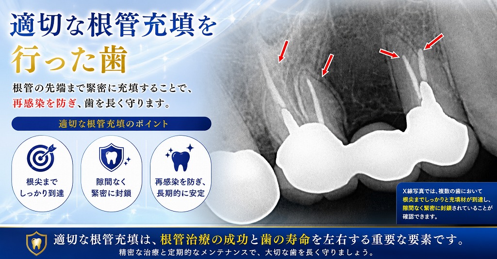 適切な根管充填を行った歯